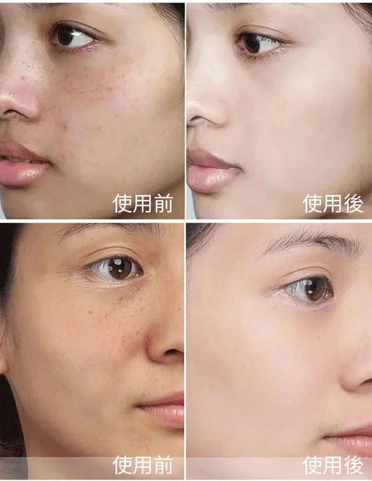 ??淡斑祛斑 美白亮膚 植物草本配方 徹底去除斑點 ??時尚雜誌和媒體傾情推!!!